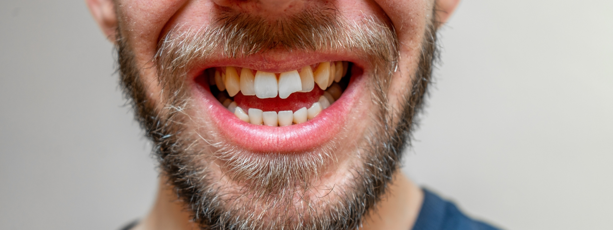 Broken Tooth