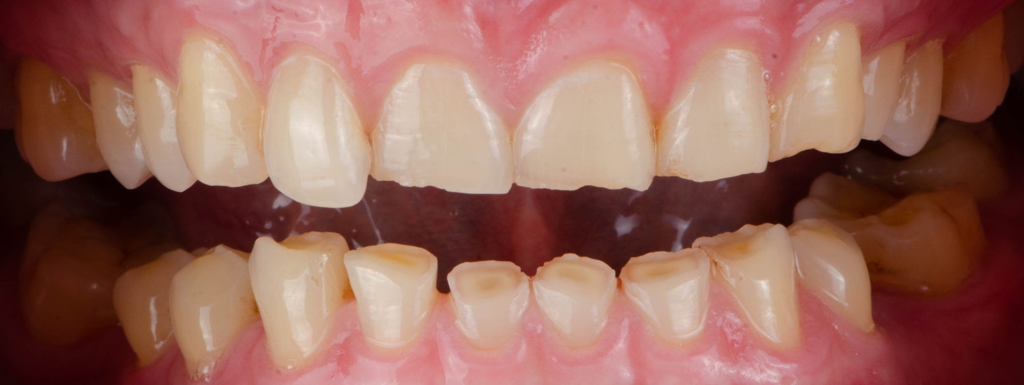 I want dental implants, but my dentist doesn’t provide them