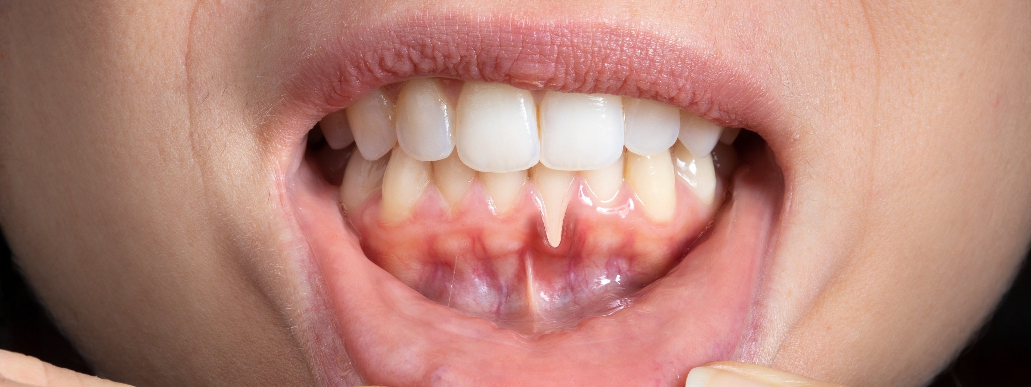 Receding Gums