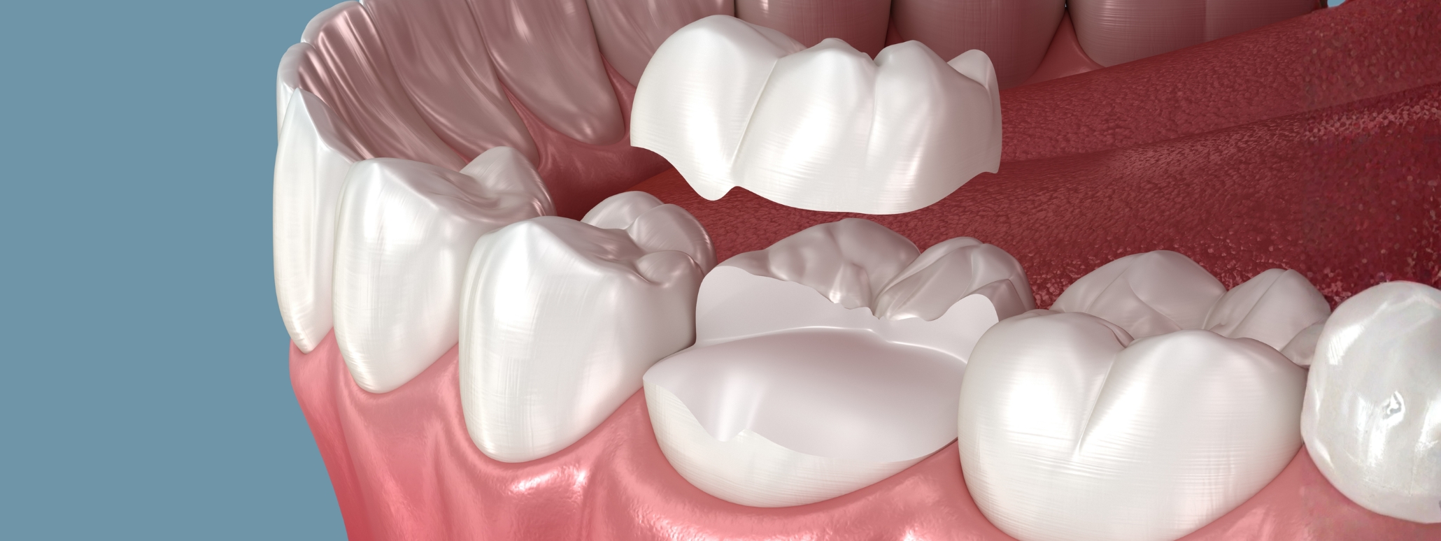 Dental Inlays & Onlays