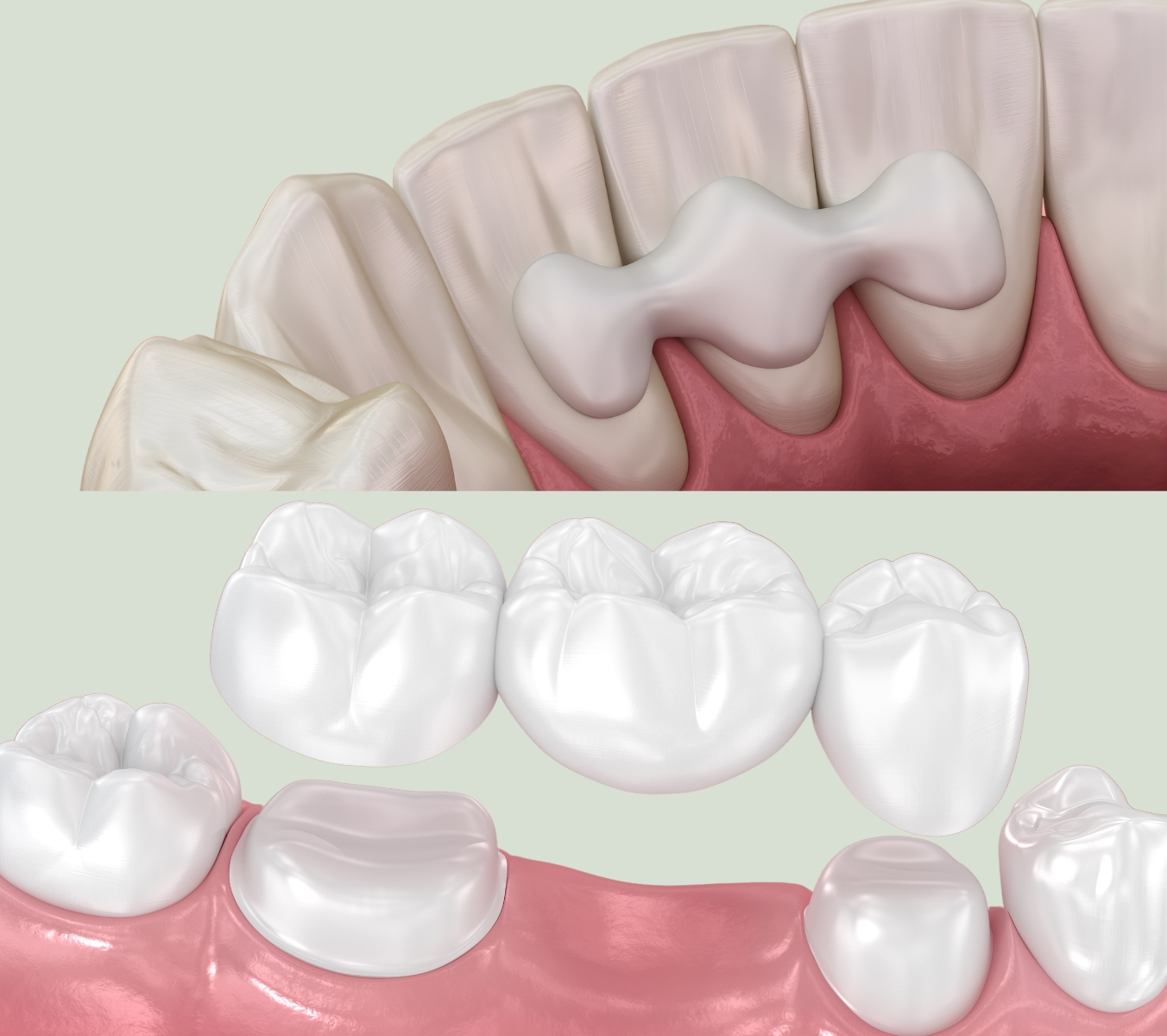 Conventional vs resin-retained bridges