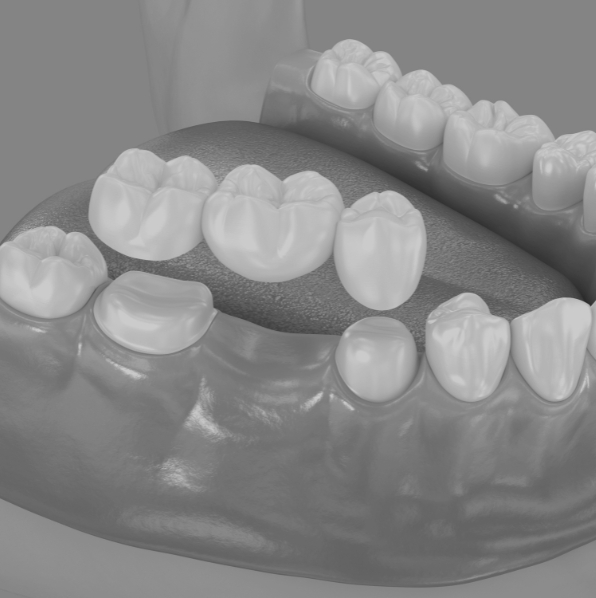 Dental Bridges