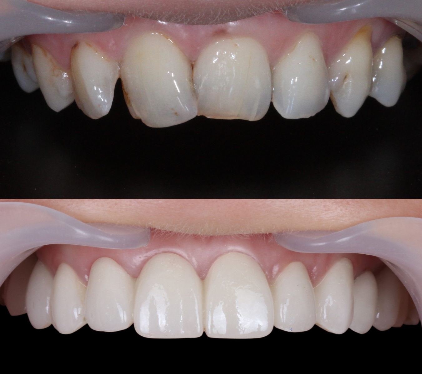 Why might I consider composite bonding?